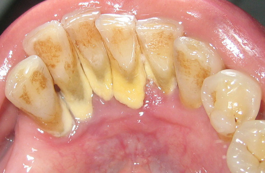 fogkő eltávolítás