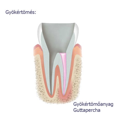 gyökérkezelés menete3